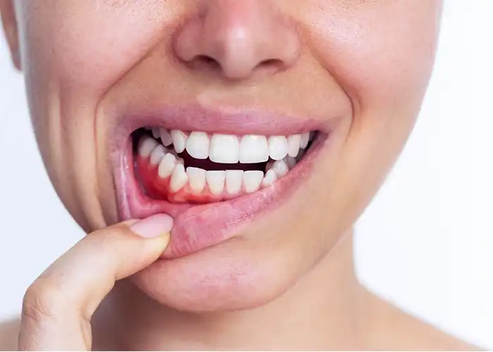 Bleeding Gums Treatment