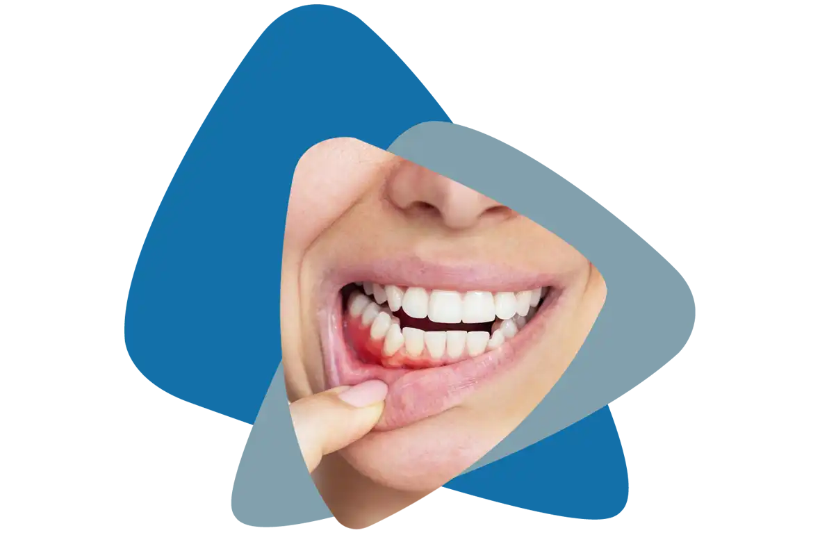 Bleeding Gums Treatment