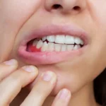 Bleeding Gums? Causes and Treatment Options in Woden Valley