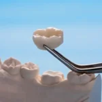 Same-Day Tooth Repair in Canberra
