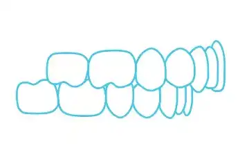 Are Spark™ Aligners Right for You?