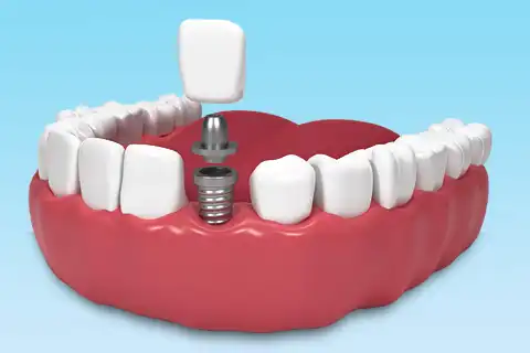 Single Tooth Implants