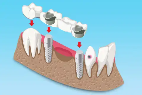 implant-supported bridges.