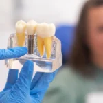 What Are Dental Implants? A Beginner’s Guide