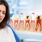 What Happens if You Delay a Necessary Root Canal?